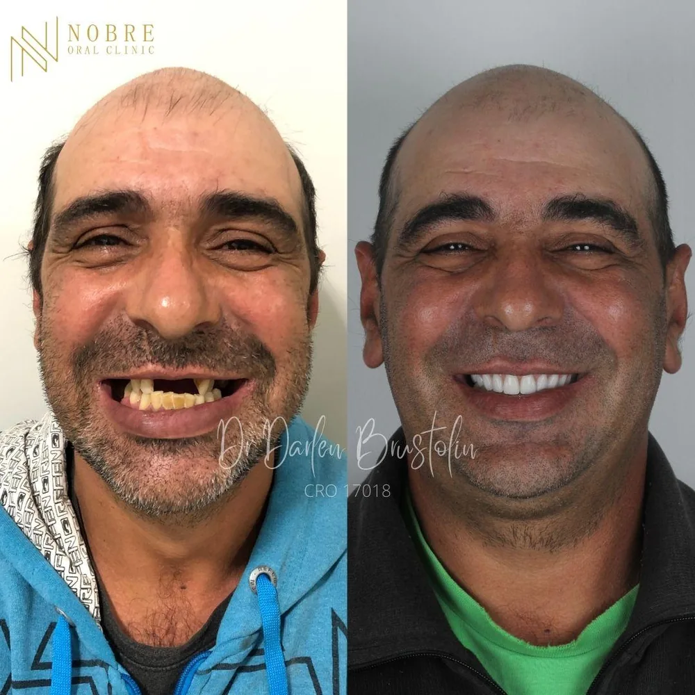 Paciente da Nobre Oral Clinic antes e depois da reabilitação com dentes fixos