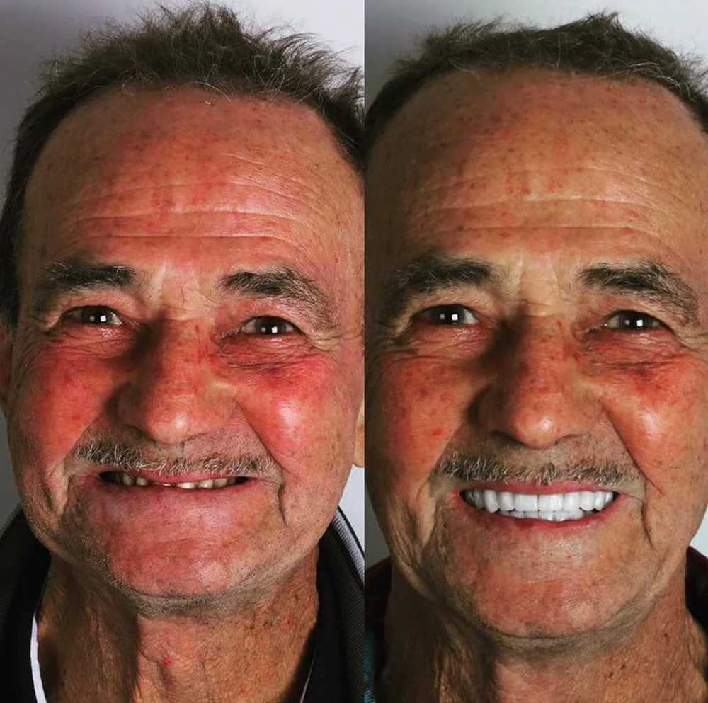 Antes e depois de paciente reabilitado com implantes na Nobre Oral Clinic