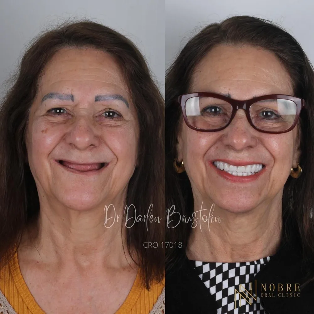 Transformação do sorriso com prótese fixa na Nobre Oral Clinic