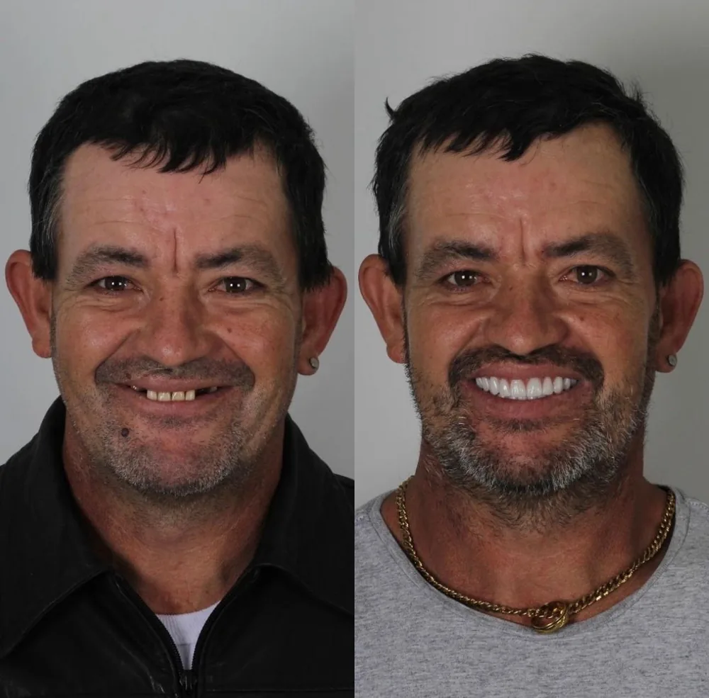 Paciente da Nobre Oral Clinic antes e depois do protocolo de dentes fixos
