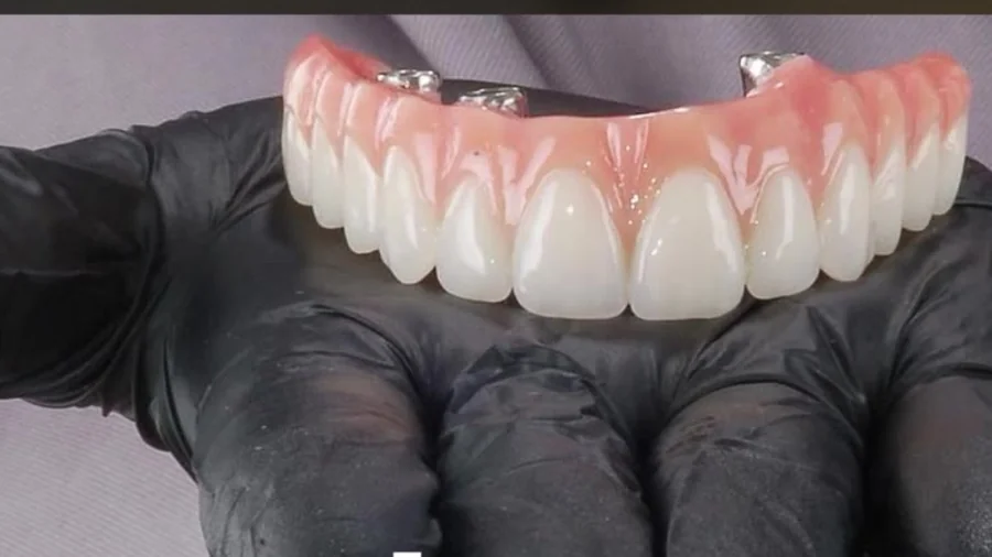 Prótese protocolo de dentes fixos sobre implantes